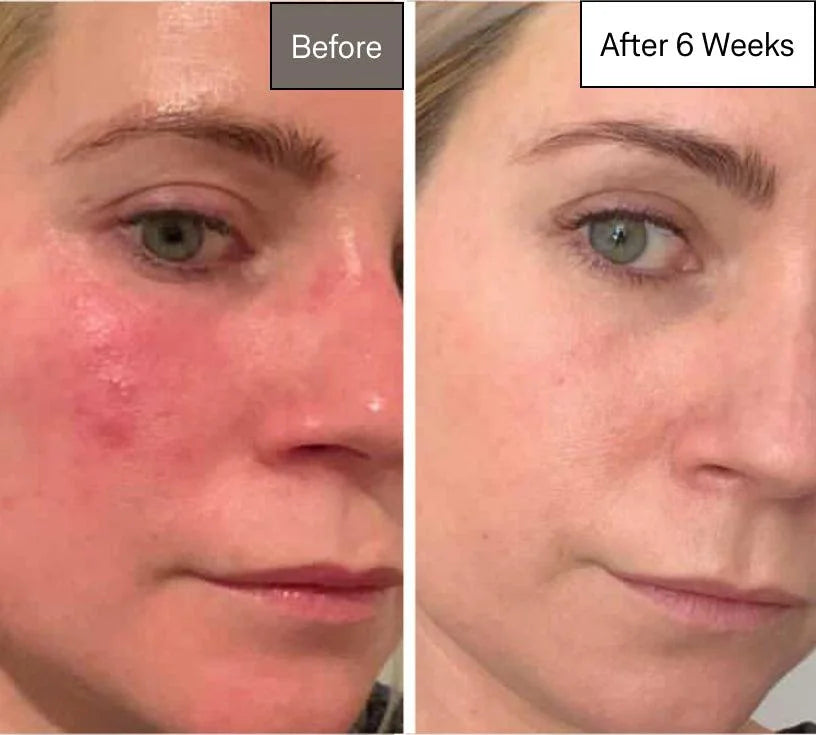 Omnilux Contour LED Light Therapy Mask