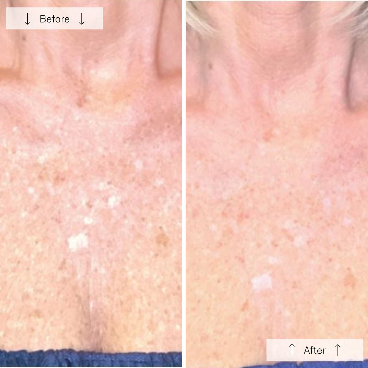 Omnilux Contour Neck and Deécolleté