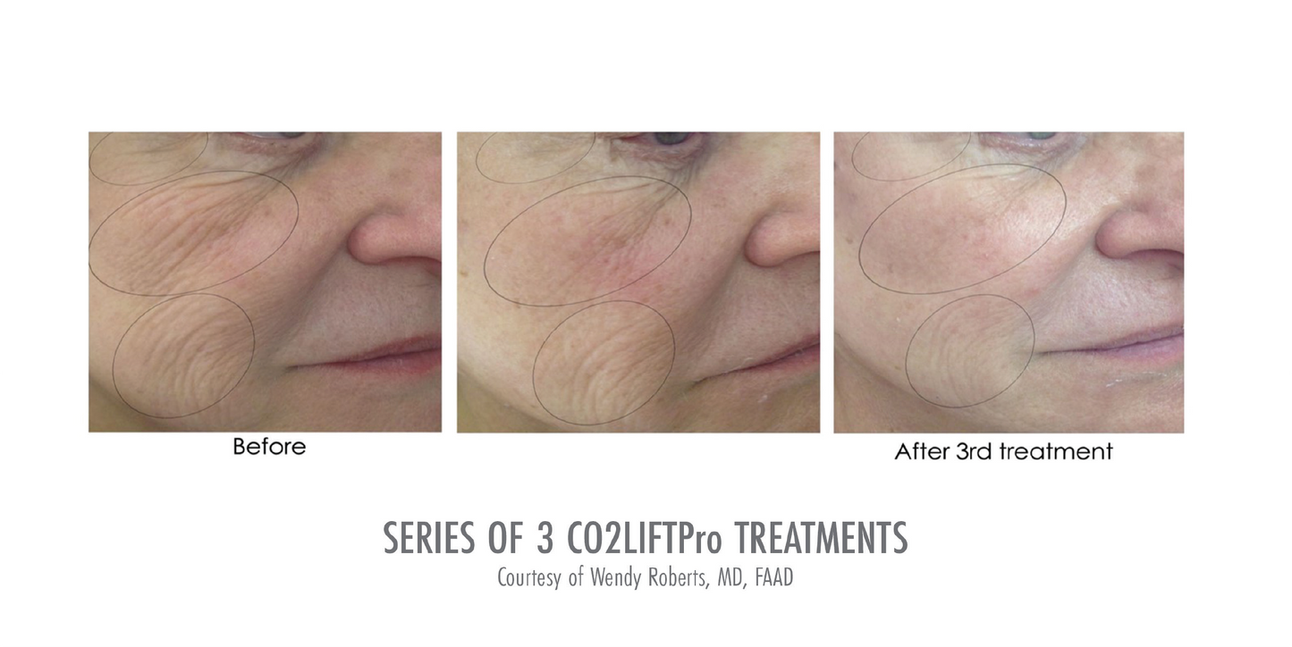 CO2LIFT® PRO Gel Mask