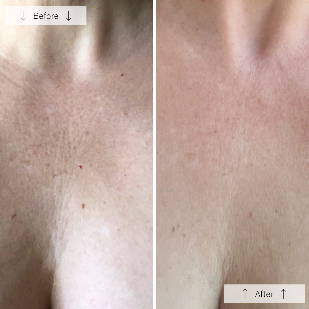 Omnilux Contour Neck and Deécolleté