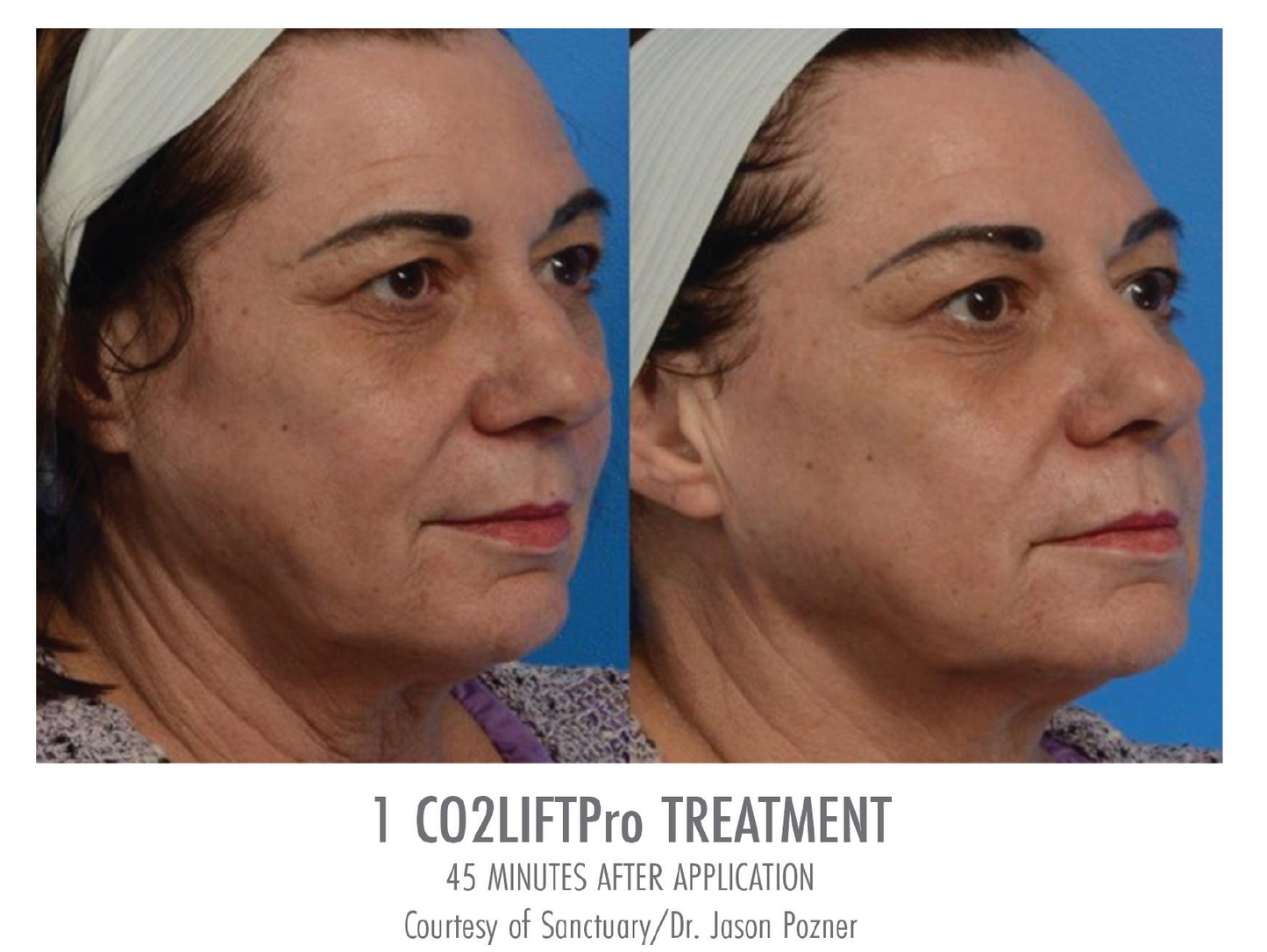 CO2LIFT® PRO Gel Mask