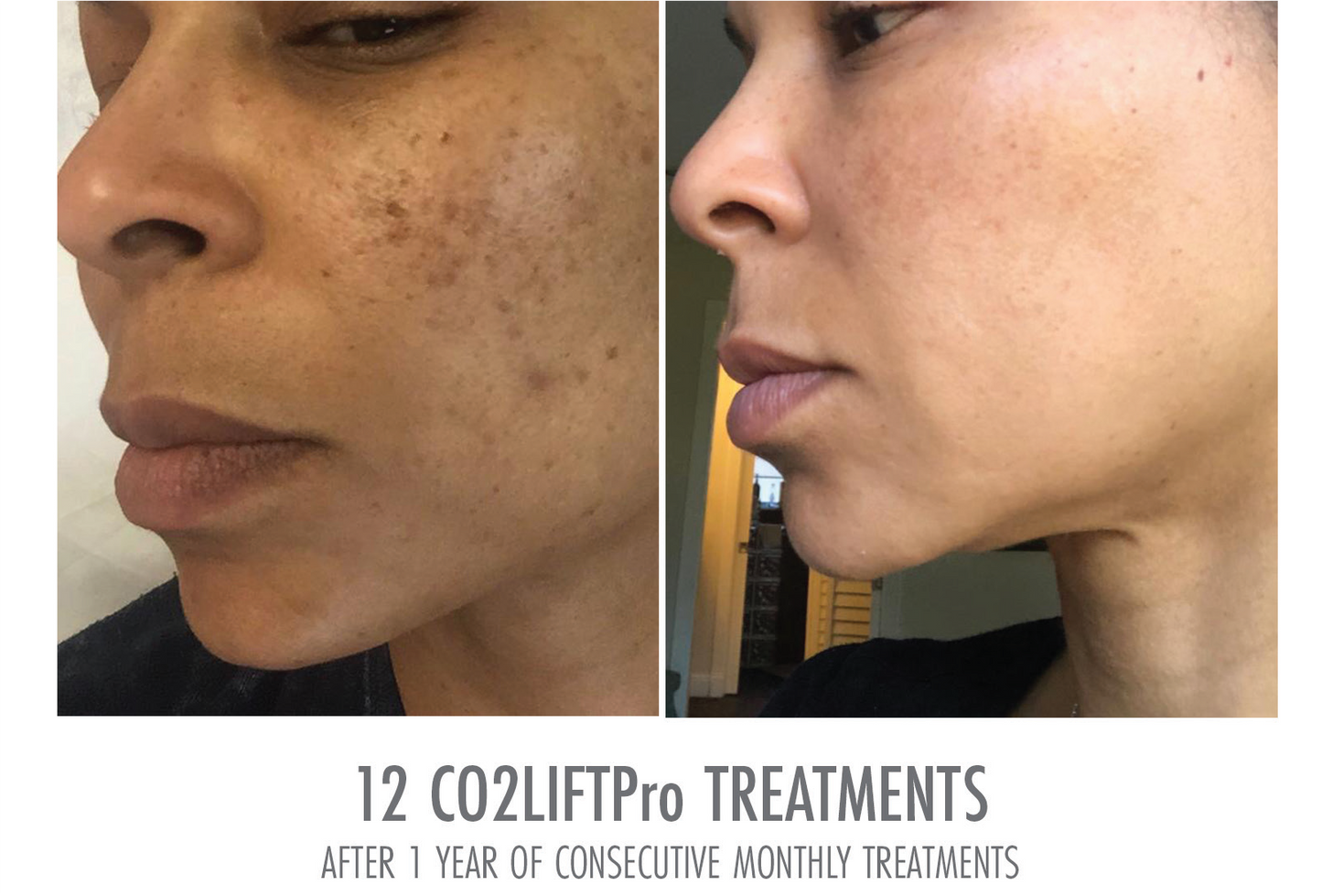 CO2LIFT® PRO Gel Mask